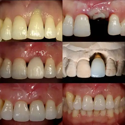 下门牙种植牙怎么样?