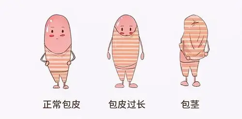 包茎:包皮口狭小,使得包皮不能外翻,阴茎头不能外露.