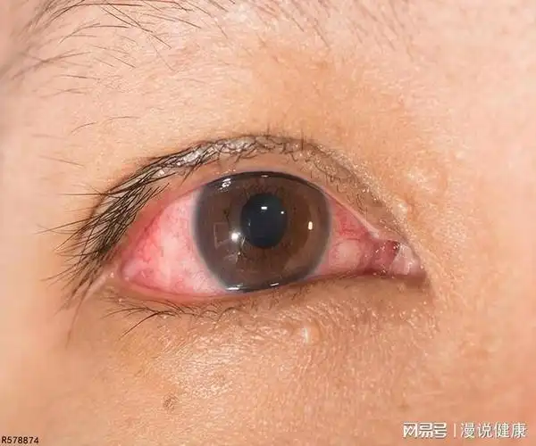 眼睛出现红血丝,是因过度用眼而致?非也,还可能与这3种病有关
