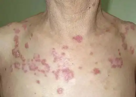 这可能是乳腺癌,肝癌的外在表现.3皮肤瘙痒