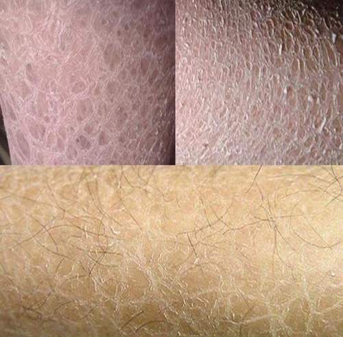 去除鱼鳞蛇皮肤起皮身体乳滋润干性肤质干燥脱皮鸡皮肤霜鸡皮肤治