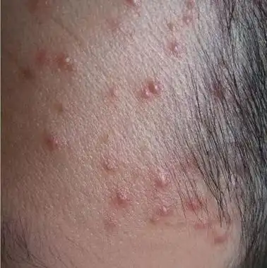 毛囊炎的危害毛囊炎的出现,起初对身体的影响并不大,轻度也只会对外观