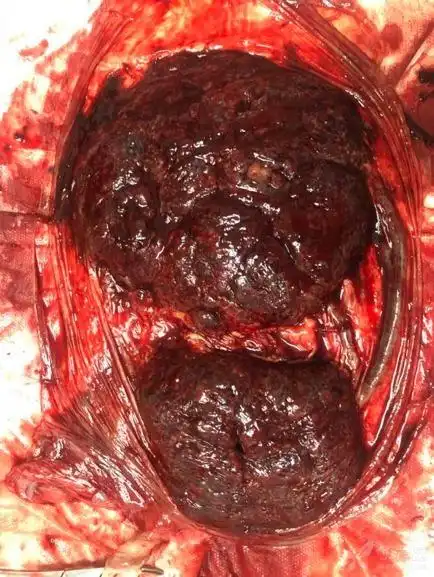 当心!临床你可能会遇见这 5 种形态特殊的胎盘