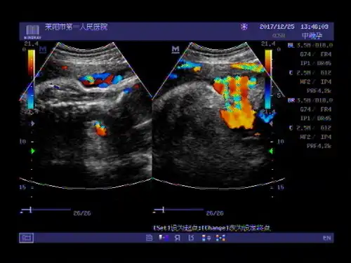 超声入门贴664---晚孕脐带绕颈三周