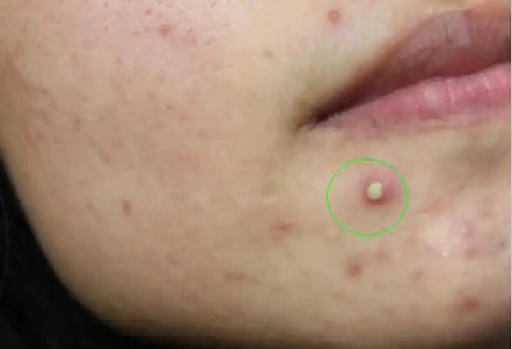 阴茎长毛囊炎的症状图片