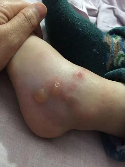 女儿两岁三个月了,身上偶尔会长个这种水泡起来,是怎么引起的,上午就