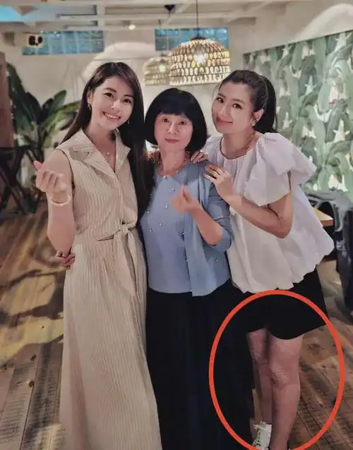 任家萱过母亲节罕见穿短裤双腿烧伤疤痕暴露无遗粉丝直呼心疼