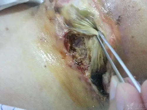 皮肤撕脱伤后脂肪液化坏死