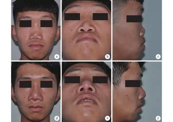 自体肋软骨移植技术修复 binder 综合征的疗效评价