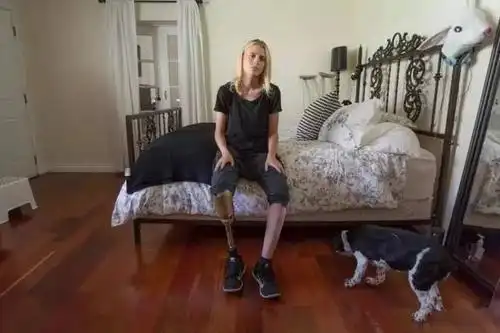 虽然经过多番治疗,但她的右腿还是没能保住,最后进行了截肢手术.