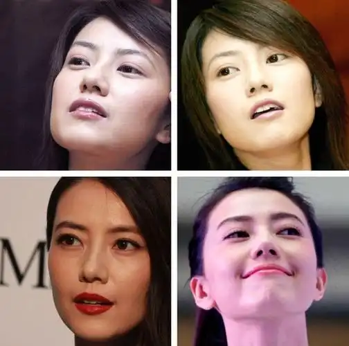 可电视机变成了宽屏后,高圆圆的脸型成了硬伤,颧弓外扩,下颌角外翻,方