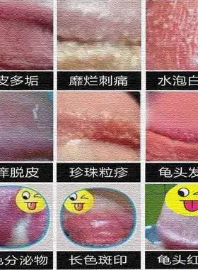 治疗白色念珠菌珍珠疹软膏鬼消炎膏