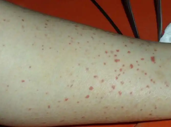 小腿痛有时小腿好像发热一样小腿疼的 小腿上有红色斑点大腿上血管青