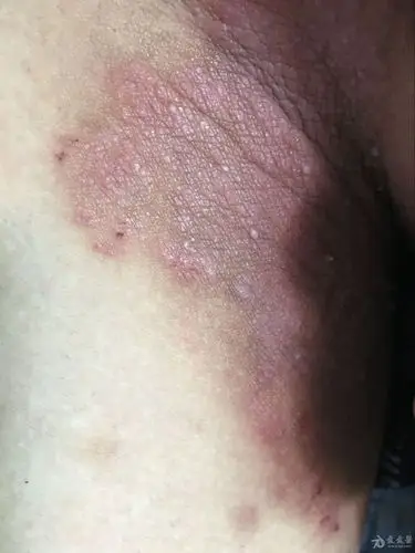 有奖猜图积分大派送三十二1股癣2神经性皮炎