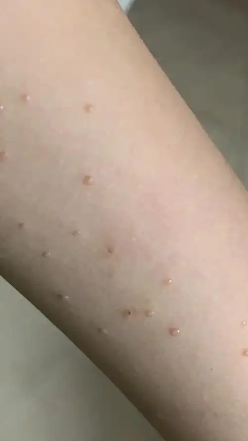 传染性软疣_介绍_治疗方式 - 好大夫在线