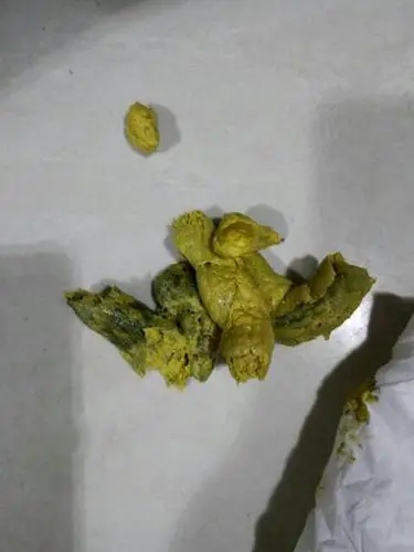 胃癌黑大便图片 (29)