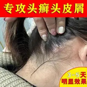 脂溢性皮炎儿童头皮癣头皮屑毛囊真菌感染去面部根除头癣特效药膏