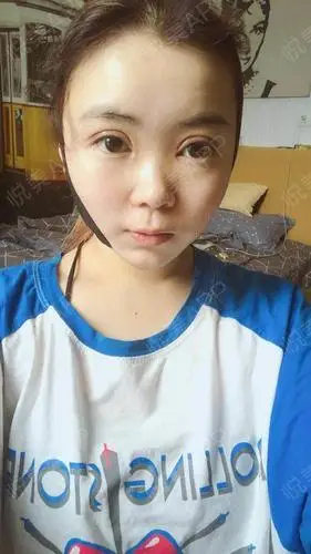 恢复期一定要照顾好自己啊,我就是恢复期没有注意御寒.