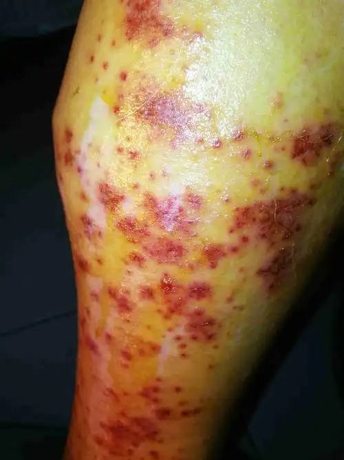 腿上起的红斑帮看下,谢谢