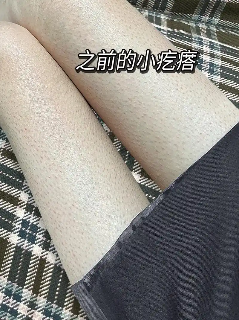 闺蜜给我介绍一个方法,这个#鸡皮肤解决方法 男士也可以用,尿 - 抖音