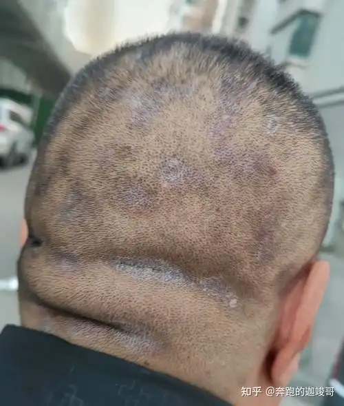 这是头癣吗请问怎么办