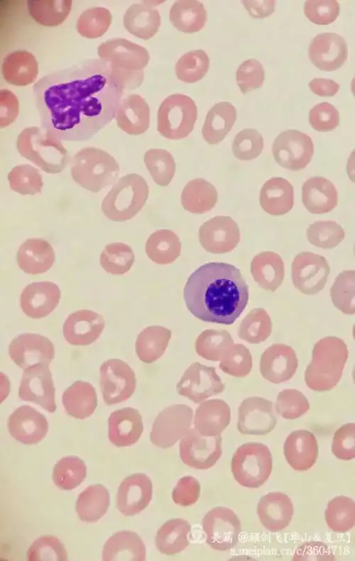 外周血中有核红与幼稚粒