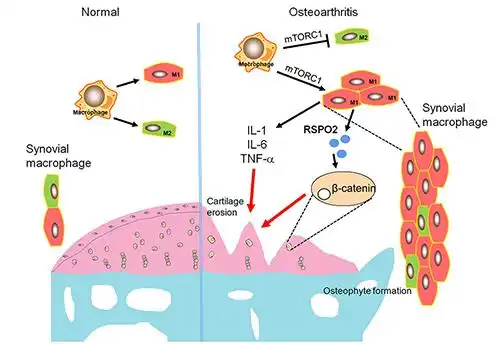 滑膜巨噬细胞m1极化促进骨关节炎发展的机制模式图