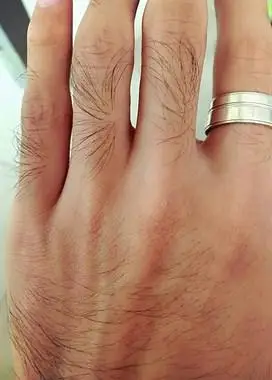 桐乡小哥用生发水洗头没带手套,手毛长得比头发快