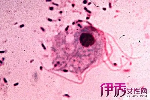 【图】滴虫和霉菌的区别是什么 分清两种病症对症下药