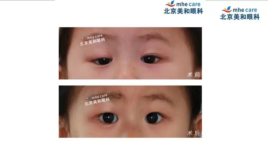用匠人精神做儿童上睑下垂手术_上睑下垂_上睑下垂治疗方式 - 好大夫