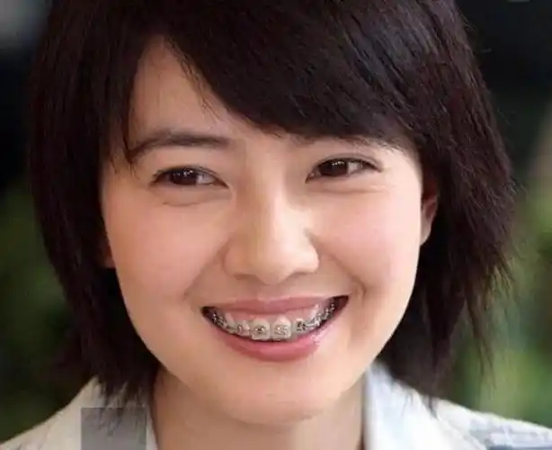 整牙后的女明星前后对比差距太大,颜值提高后爆红_网易订阅