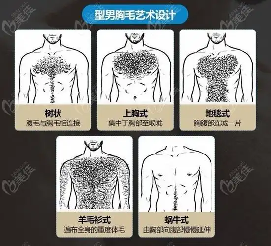 胸毛种植的类型236z.com