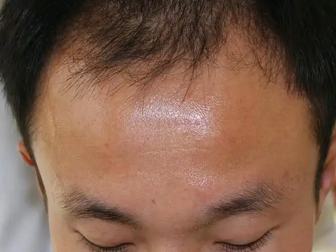 这是术前情况,自己本身是一个程序猿,熬夜比较多