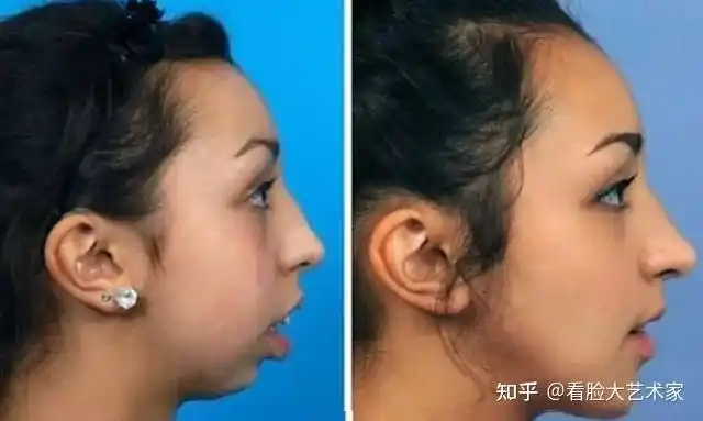 如何长出又尖又翘的小下巴?