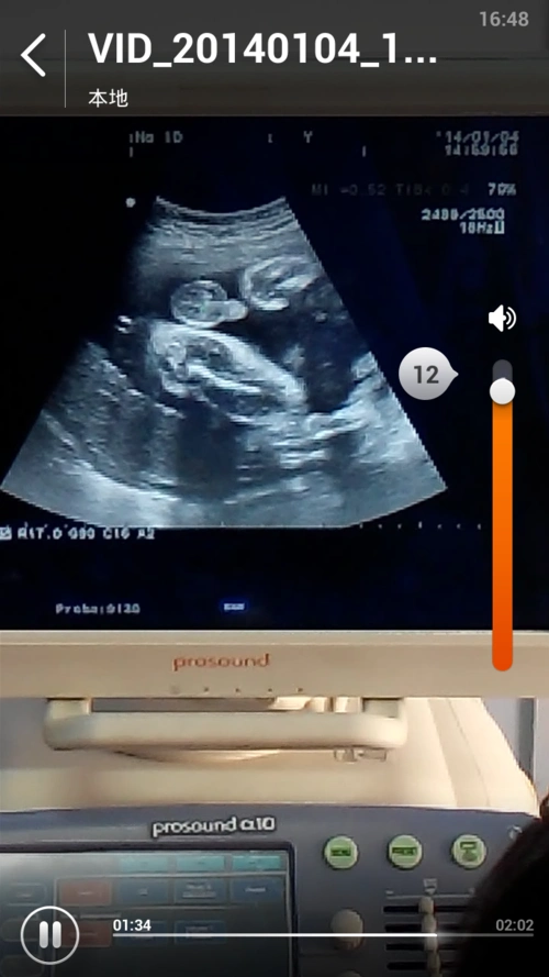 推荐回答 病情分析:   您好,你的情况,常规b超检查是不能确定胎儿性别