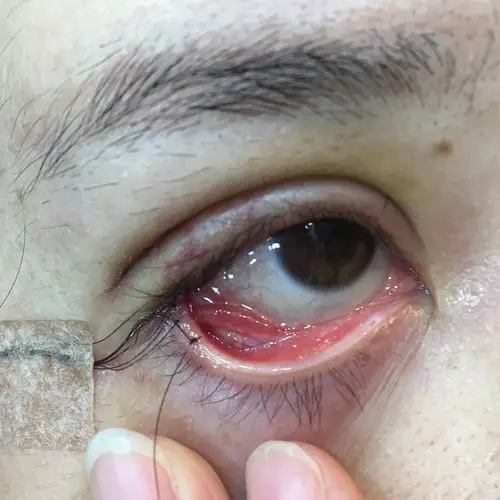 请问下眼睑下至和开外眼角七天了,下眼睑这里的组织是多余的吗?