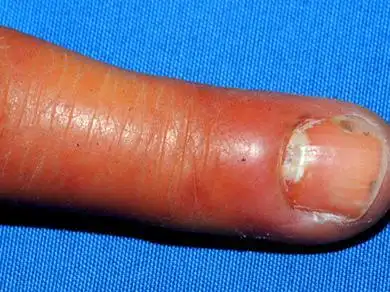 念珠菌性甲沟炎