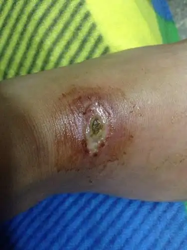 伤口发炎化脓了怎么办