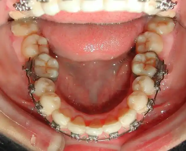 儿童牙齿矫正的最佳年龄段