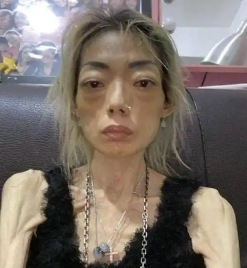 名模恋上伪富豪,8年内为他瘦成皮包骨头,患病瘫痪惨遭抛弃