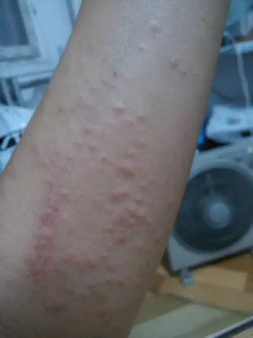 请问这是什么症状,是什么皮肤过敏吗?