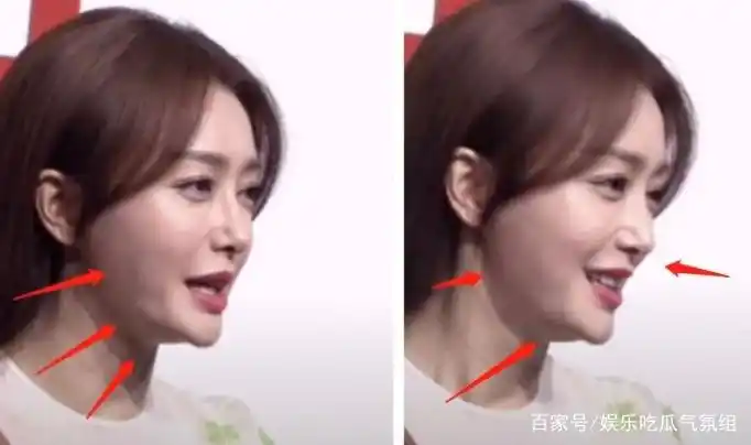 讽刺!小方脸成真香系列,那些削骨留下后遗症的明星后悔死了吧!