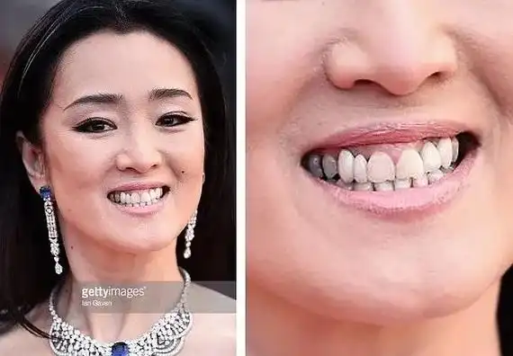 为什么明星的烤瓷牙都比较真实?的明星做了烤瓷牙(4)