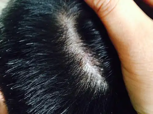 头皮有厚头屑,严重时大部分头皮均有厚薄不一的头屑状物,个别地方头皮