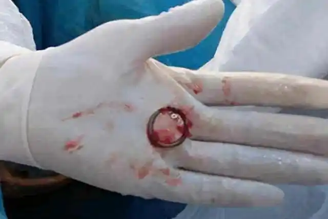 我国首批"上环"女性已步入晚年,但妈妈们的现状,却令人担忧|避孕|子宫