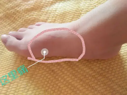 早上十点多起来走路的时候,右脚只要一用力图中的地方就很痛(或者