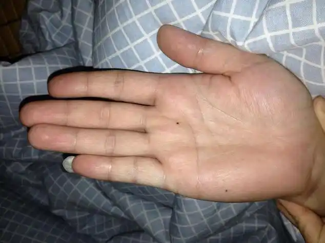 手掌有黑痣代表什么意思