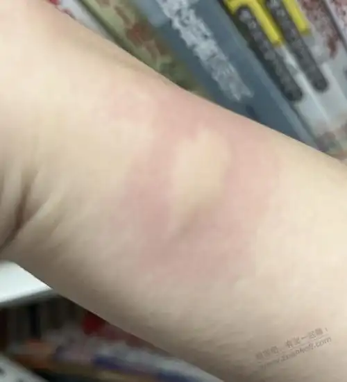 中午做的虾吃完就过敏了