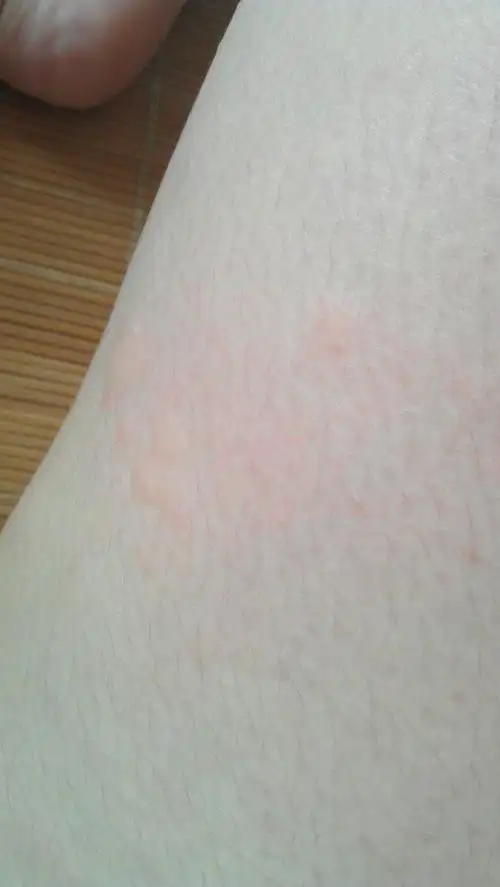 最近我的大腿不知怎的很痒,抓过之后就起红疙瘩了,怎么回事?