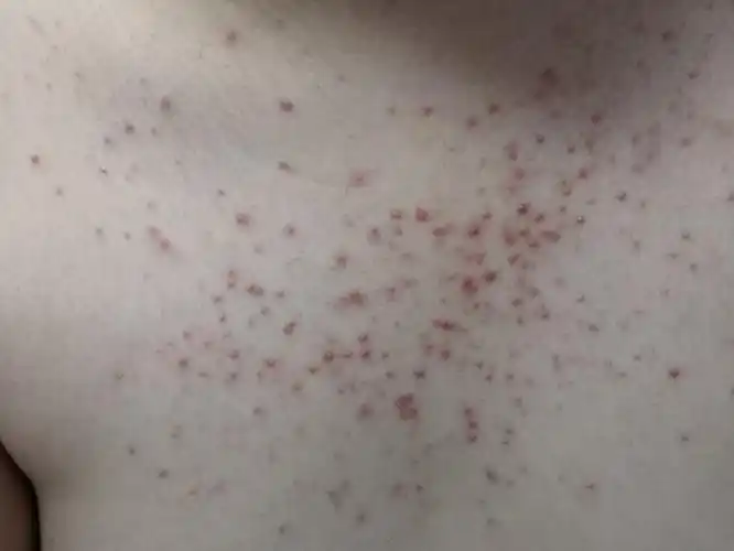 诊断马拉色菌毛囊炎症状.